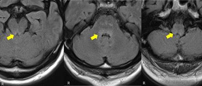 Gait instability, ophthalmoplegia, and chorea with orofacial dyskinesia in a man with anti-Ri antibodies: a case report